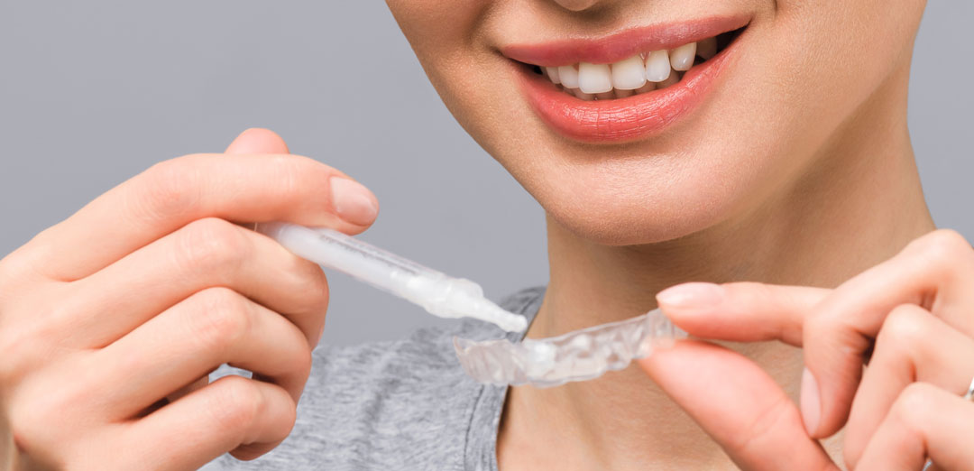 Can I Whiten My Teeth During Invisalign® Treatment?