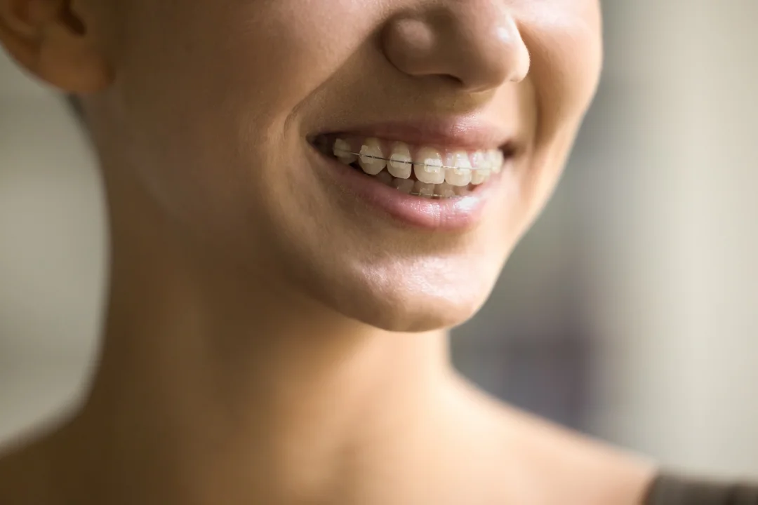 Discreet fixed braces: ceramic vs Iconix champagne braces