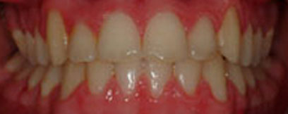 Before & Afters