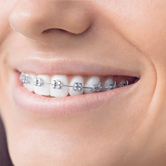 Braces