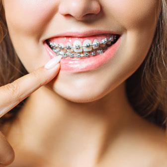 NHS braces