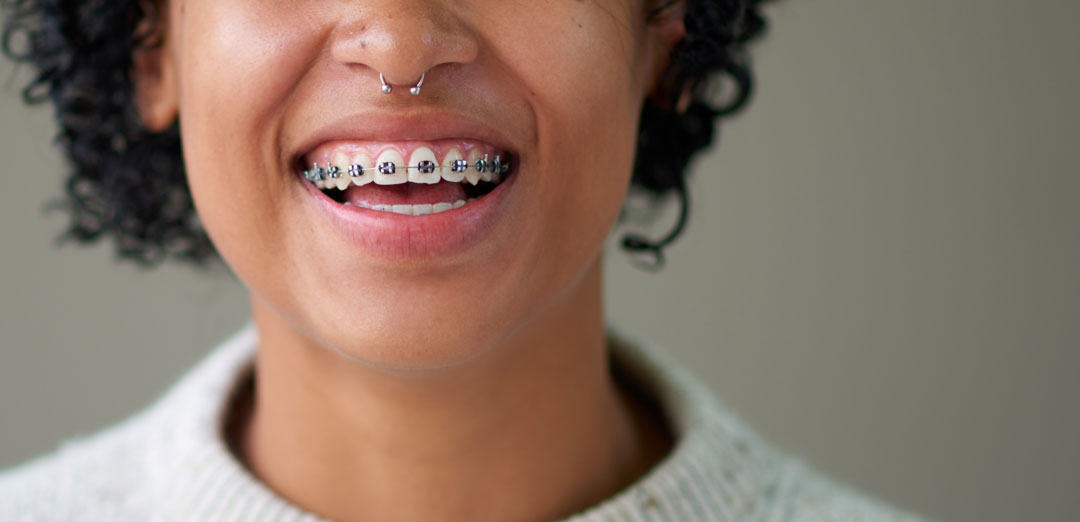 Do braces hurt more than Invisalign®